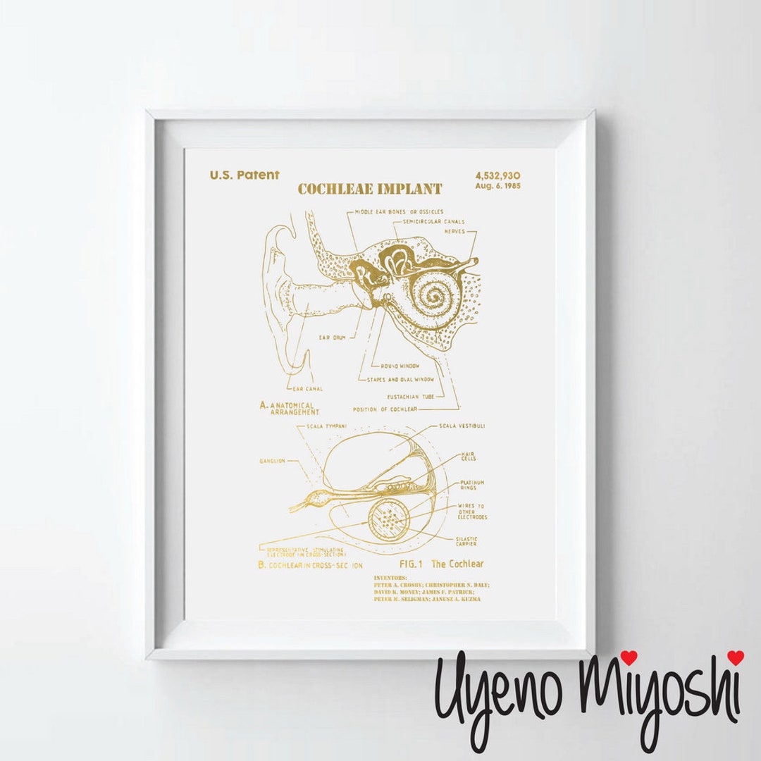 Cochlear Implant Gold Print, Ear Anatomy Print, Inner Ear Diagram ...