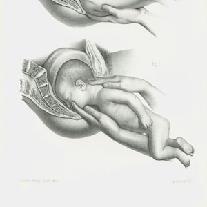 1865 Geburt, menschlicher Fötus, original anatomisches Brett, Poster Anatomie Geburtshilfe Gynäkologie Embryologie