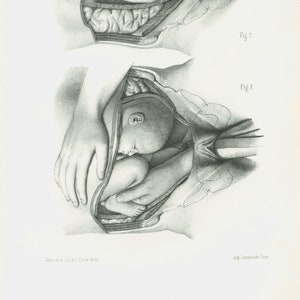 1865 Geburt, Geburt, menschlicher Fötus, Original anatomische Platte, Poster Anatomie Geburtshilfe Gynäkologie Embryologie