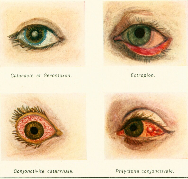 1912 Eye Anatomy Eye Disease Wall Eyes Minnow Medicine & Etsy
