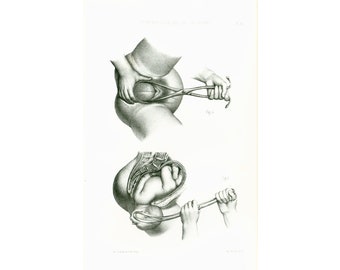 1865 Forceps Childbirth, Human Fetus, Original Anatomical Plate, Poster Anatomy Obstetrics Gynecology Embryology