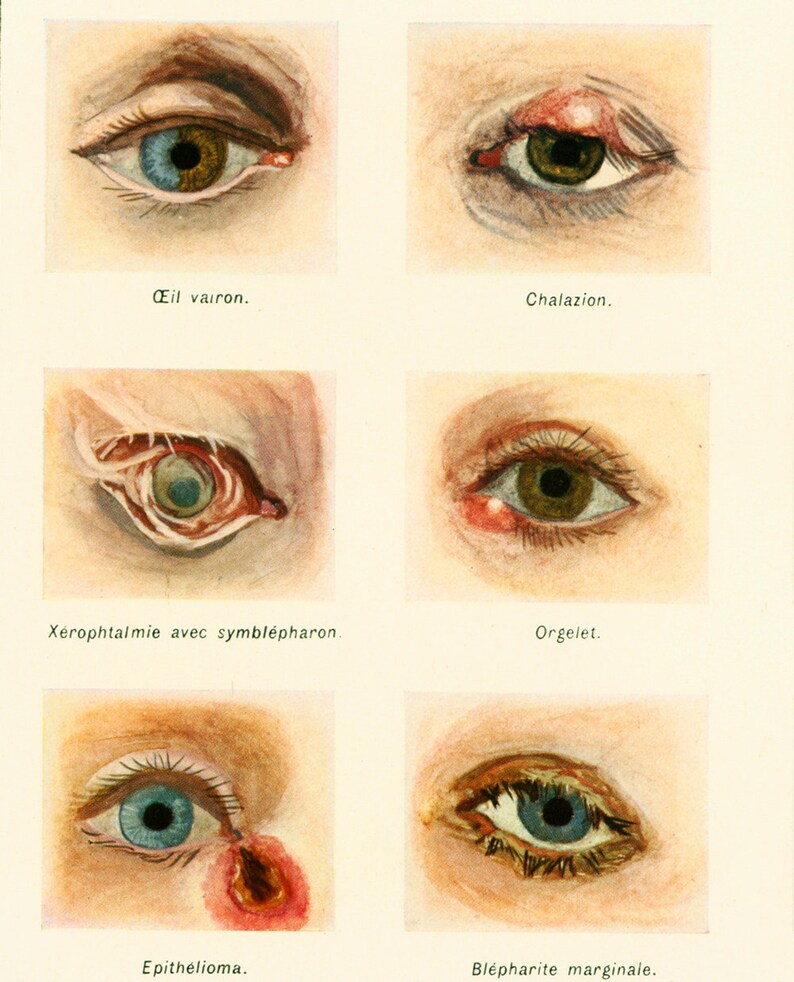 1912 Eye Anatomy Eye Disease Wall Eyes Minnow Medicine & Etsy