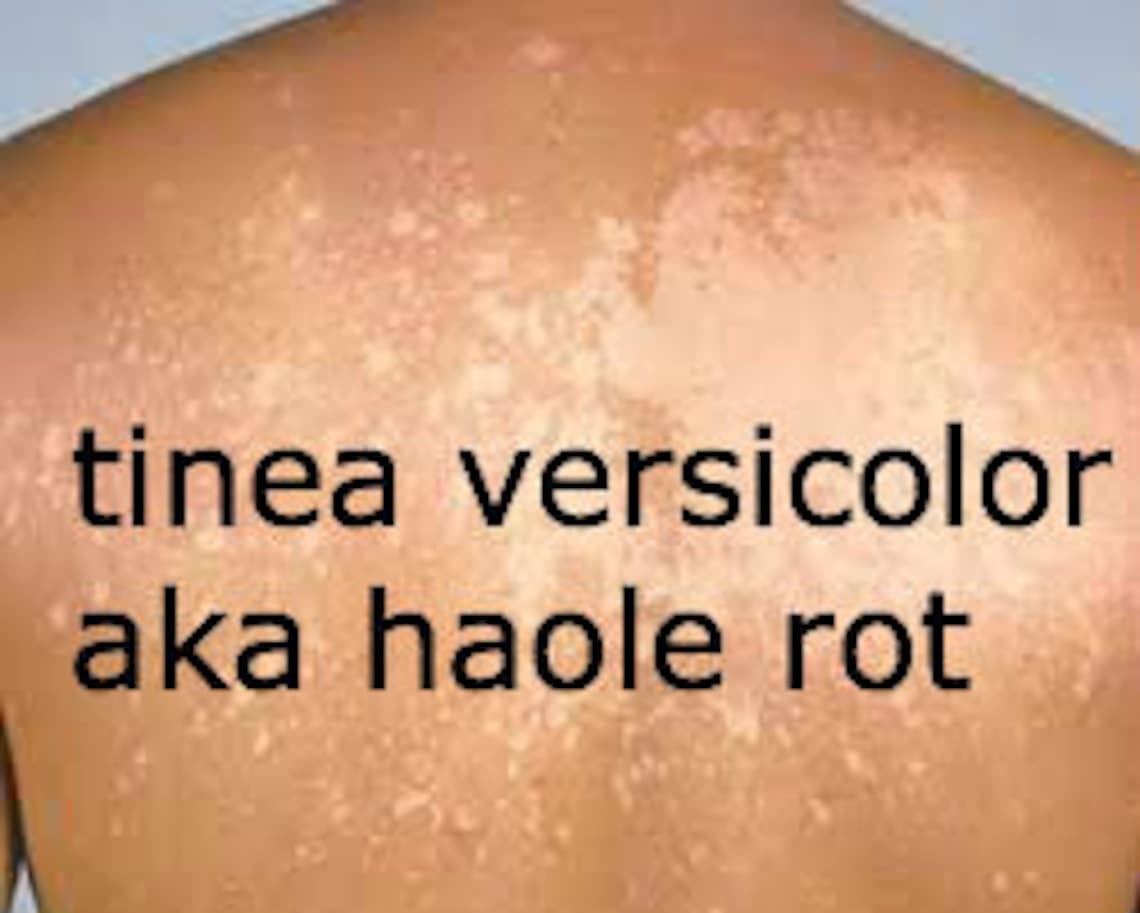 Tinea Versicolor treatment Natural Tinea Versicolor Remedy Etsy