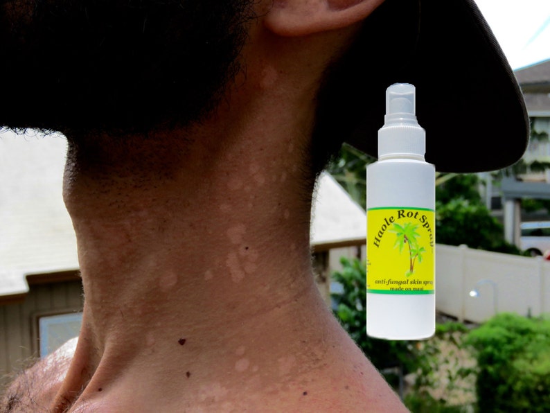 Tinea Versicolor Treatment Natural Tinea Versicolor Remedy Etsy Canada