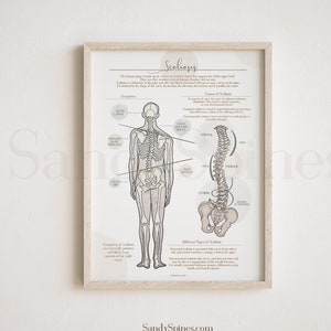 Scoliosis Anatomy Poster | SANDYSPINES |Art for Chiropractors, physical therapists, Osteopaths and More