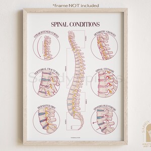 Spinal Conditions  and Injury Poster | SANDYSPINES | Art for chiropractors, massage therapists, PTs