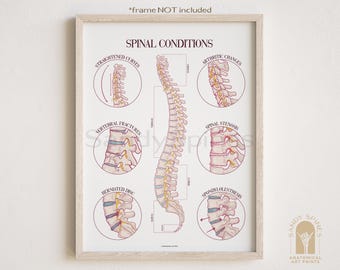 Spinal Conditions  and Injury Poster | SANDYSPINES | Art for chiropractors, massage therapists, PTs