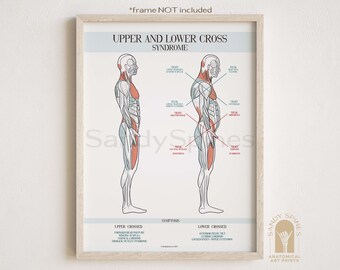 Upper & Lower Cross Syndrome Poster | SANDYSPINES | Art for Chiropractors, physical therapists, Osteopaths and More