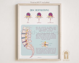 Disc Herniation Injury Poster by SandySpines | Chiropractic Physical therapy Art + Posters