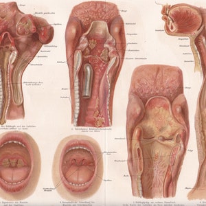 1890 DISEASES of the THROAT and LARYNX Antique Lithograph, Croup, Tuberculosis, Vocal Cord Polyp, Esophageal Cancer, Diphtheria, Tonsillitis