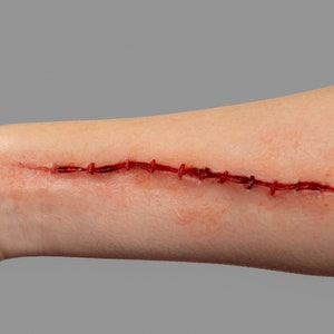 May include: A close-up of a stitched wound on a person's arm. The wound is red and has several stitches.
