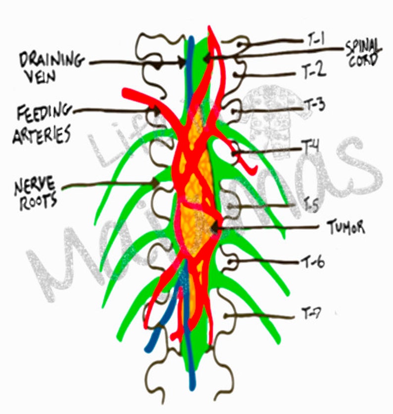 Grey's Anatomy Wall Tumor PNG Etsy