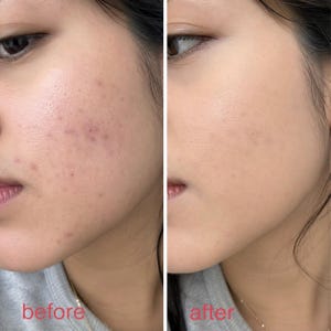 May include: A split-screen image showing a side-by-side comparison of skin before and after a cosmetic application. The left side, labeled "before," displays skin with visible blemishes. The right side, labeled "after," shows smoother skin with an even tone.