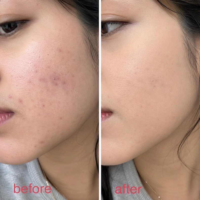 May include: A split-screen image showing a side-by-side comparison of skin before and after a cosmetic application. The left side, labeled "before," displays skin with visible blemishes. The right side, labeled "after," shows smoother skin with an even tone.