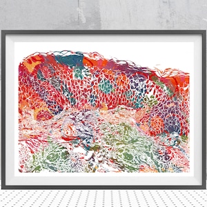 Contact Dermatitis Anatomy Print Dermatology Watercolor Microscopic View Of The Epidermis Showing Spongiotic Dermatitis Medical Art