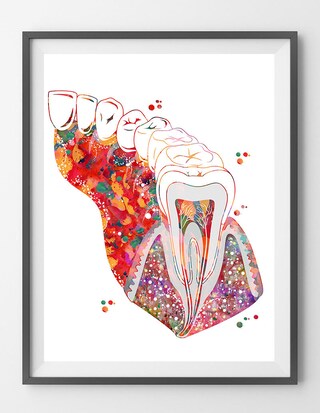 Quadro Su Tela Per Dentista: Stampa Dentale Con Impianti E Acquerello, Poster 50x70cm Senza Cornice, Decorazione Studio Dentistico O Clinica