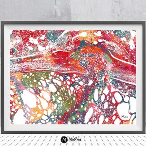 Thyroid cancer watercolor print abstract anatomy art histology print of the follicular thyroid carcinoma endocrine system poster medical art