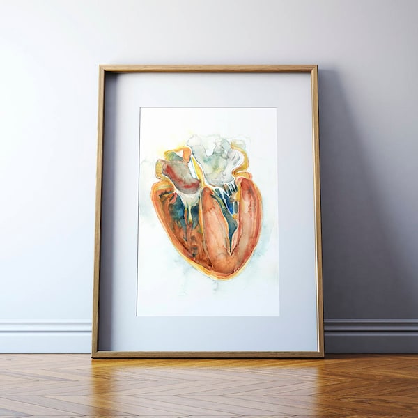 Hypertrophic Cardiomyopathy Heart Watercolor Print - Myopathy Art - Anatomy Art - Heart Painting - Cardiovascular Art