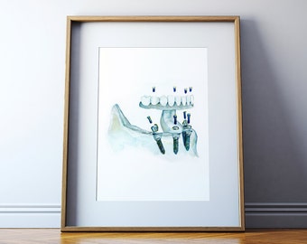 Tandheelkundige implantaten aquarel Art Print - All On 4 Art Print - OMFS en tandheelkundige anatomie kunst