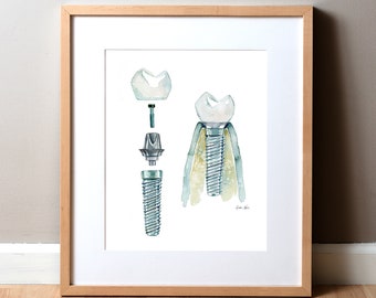 Dental Implant Watercolor Art Print - Dental Anatomy Art - Dental and OMFS Anatomy