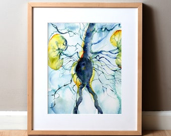 Abdominal Aneurysm Arteriogram Watercolor Print - Cardiovascular Painting - Blood Vessel Painting - Abstract Anatomy Art