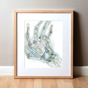 Rheumatoid Arthritis(RA) of the Hand Watercolor Print - Carpal Metacarpal and Phalanges Watercolor Print