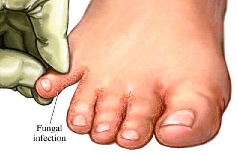 athletes foot treatment athletes foot treatment