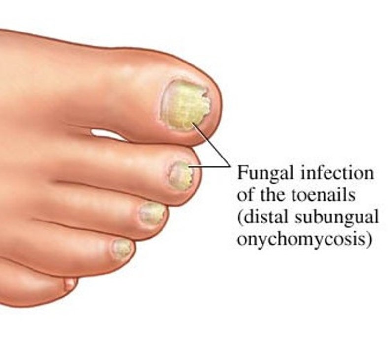 Fungal Nail Treatment Onychomycosis Antifungal Pharma Etsy UK