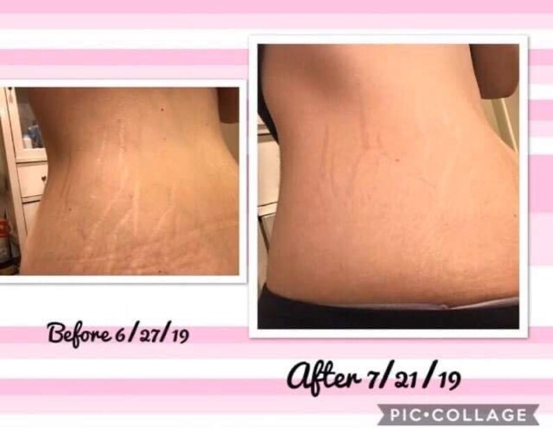 nu skin stretch mark cream