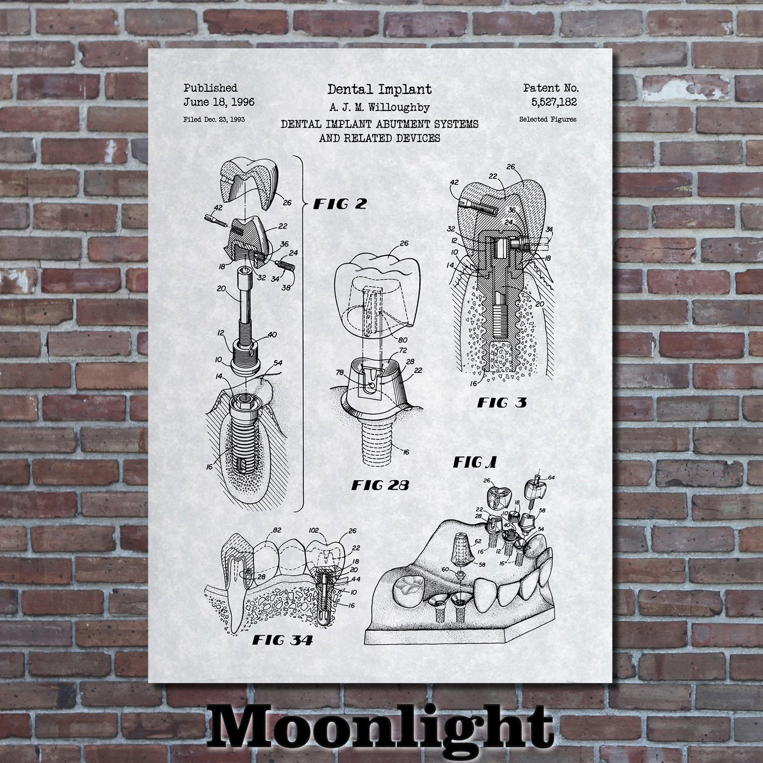 Dental Implant Patent Print Art 1996