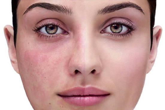 natural face wash for rosacea