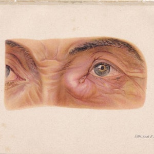 Original Antique Eye Disease Infection Remedy Diagnosis Doctor Medical Lithograph Print Human Anatomy Sight Macabre