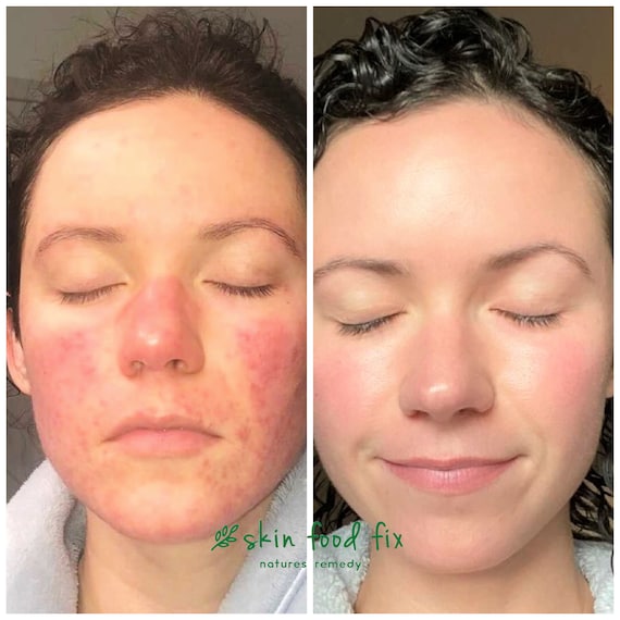 Rosacea Face Products Red Skin Sensitive Skincare Vegan Skin