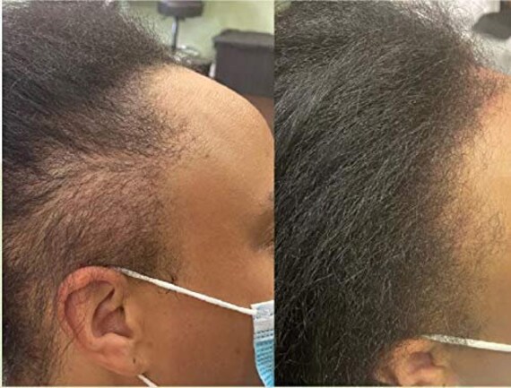 Edges Regrowth Edge Growth Hair Regrowth for Black Women - Etsy Edges Regrowth Edge Growth Hair Regrowth for Black Women - Etsy