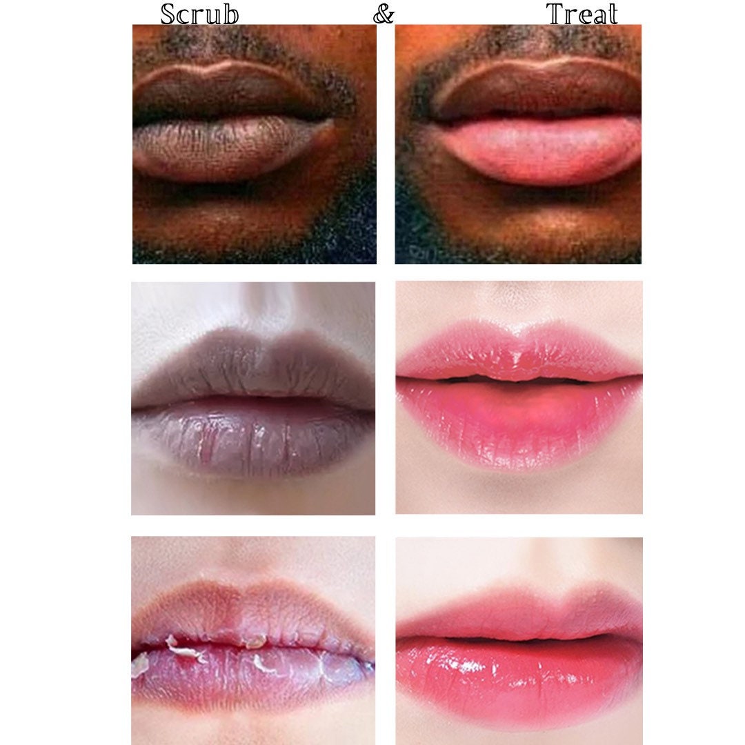 Dry Cracked Winter Lips Fix. Lips Lightening System. Smokers Etsy
