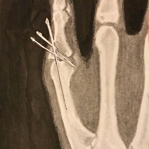 Ortopedisk kirurgi röntgen original skelettkonstverk 13,5 x 21,5 cm kol- och bläckteckning