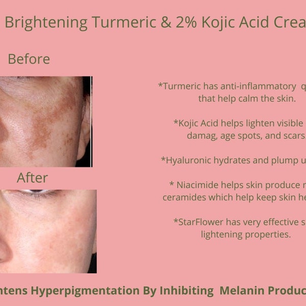 Kojic Acid Cream Etsy