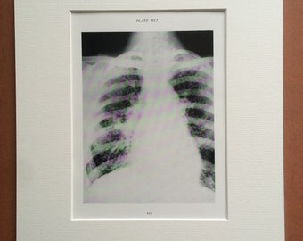 1941 Chest & Lung X-Ray Original Vintage Print - Mounted and Matted - Silicosis - Radiology - Medical Decor - Science - Available Framed