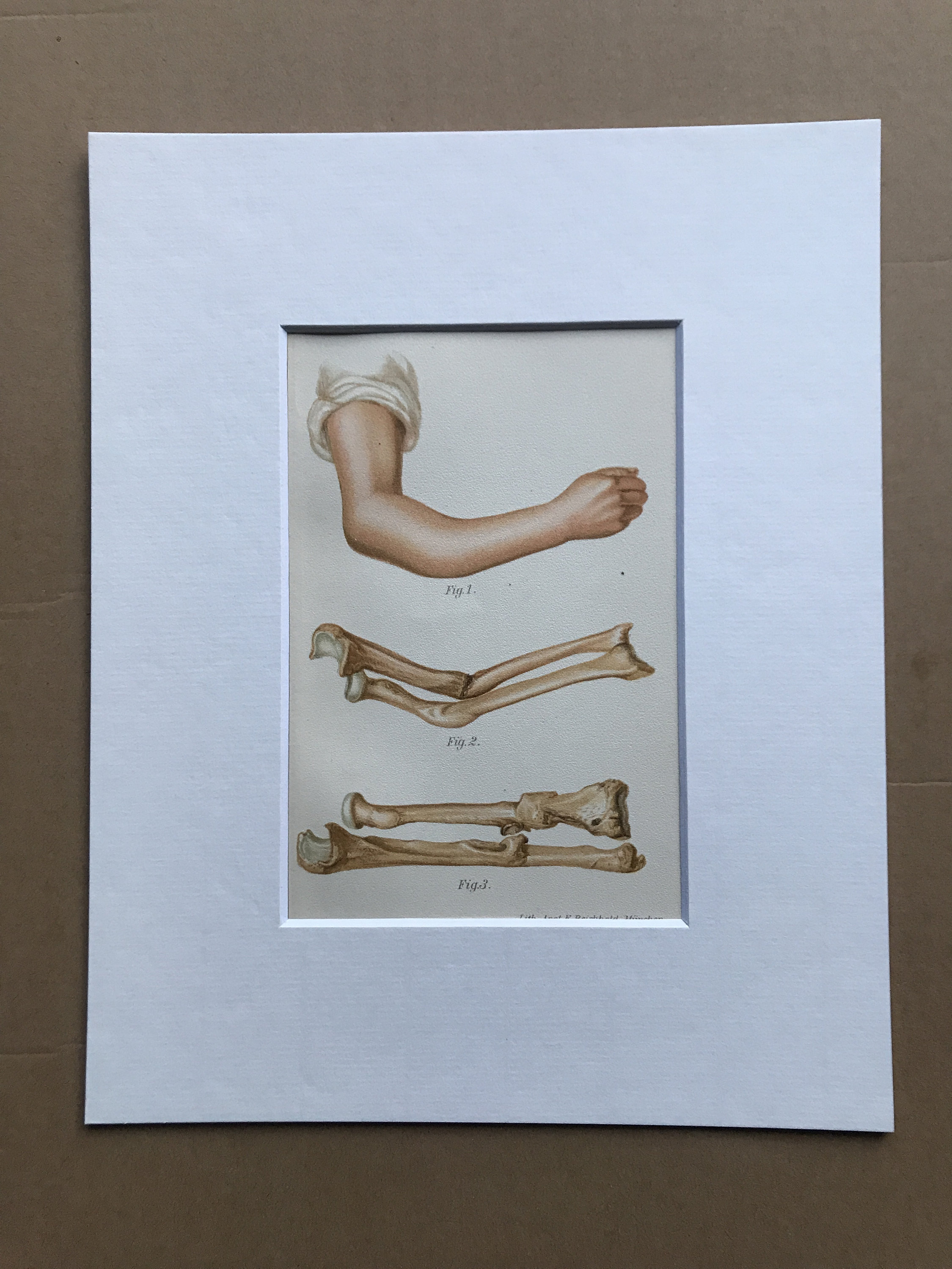 1902 Forearm Fractures Original Antique Anatomical Print Medical Decor Anatomy Mounted and