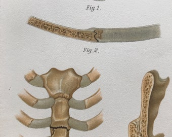 1902 Sternum Fracture Original Antique Anatomical Print - Dislocation - Medical Decor - Anatomy - Mounted and Matted - Available Framed