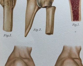 1902 Humerus Fracture Original Antique Anatomical Print - Dislocation - Medical Decor - Anatomy - Mounted and Matted - Available Framed