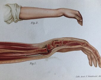 1902 Wrist Fracture Original Antique Anatomical Print - Medical Decor - Anatomy - Mounted and Matted - Available Framed