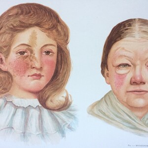 Póster anatómico original de gran tamaño de 1903 sobre enfermedades de la piel: anatomía, ciencia, dermatología, decoración de pared extraña y morbosa