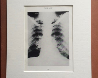 1941 Chest & Lung X-Ray Original Vintage Print - Mounted and Matted - Silicosis - Radiology - Medical Decor - Science - Available Framed