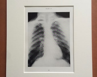 1941 Chest & Lung X-Ray Original Vintage Print - Mounted and Matted - Silicosis - Radiology - Medical Decor - Science - Available Framed