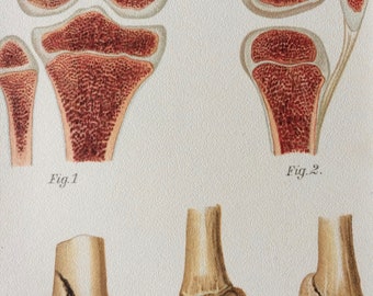 1902 Original Antique Anatomical Print - Available Mounted and Matted - Fracture - Dislocation - Medical Decor - Anatomy - Available Framed
