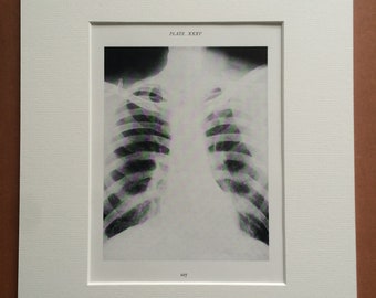 1941 Chest & Lung X-Ray Original Vintage Print - Mounted and Matted - Silicosis - Radiology - Medical Decor - Science - Available Framed