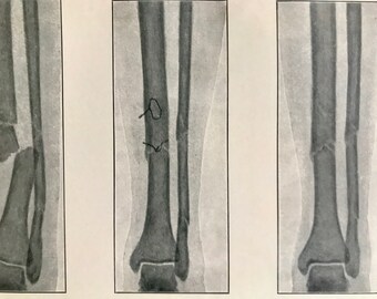 1902 Repair of Leg Fracture X Ray Original Antique Print - Dislocation - Medical Decor - Anatomy - Mounted and Matted - Available Framed