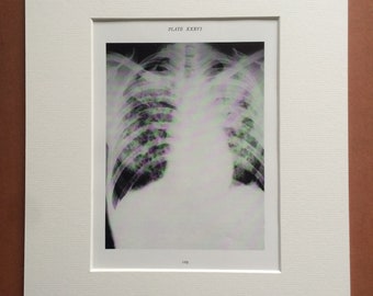 1941 Chest & Lung X-Ray Original Vintage Print - Mounted and Matted - Silicosis - Radiology - Medical Decor - Science - Available Framed