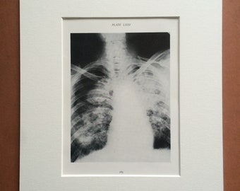 1941 Chest & Lung X-Ray Original Vintage Print - Mounted and Matted - Silicosis - Radiology - Medical Decor - Science - Available Framed